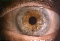 corneal_transplant