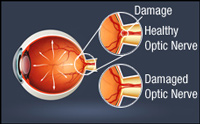 glaucoma